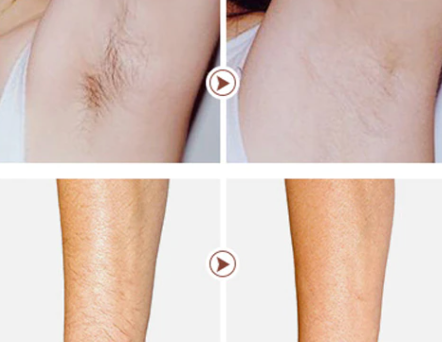 Skyline Hair Removal Companion - Sunny Skyline